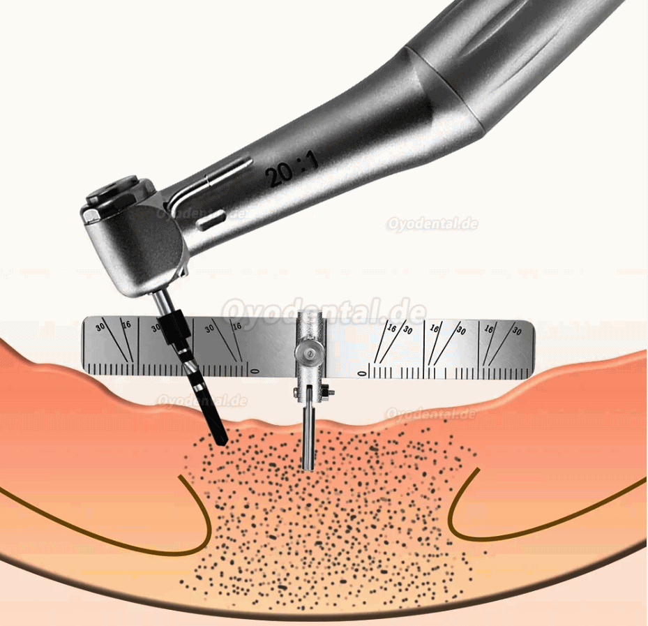 Dental Implantat Ortung Guide Chirurgische Pflanzung Positionierung Locator Lineal Gauge