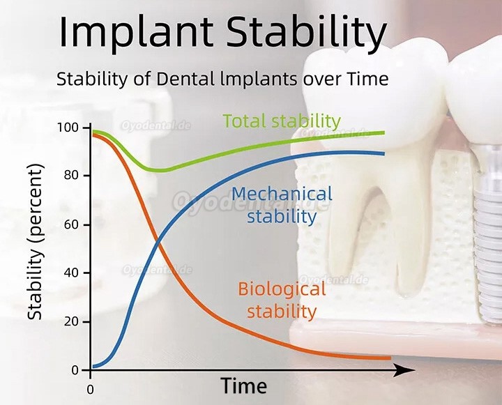 YAHOPE iCHECK Implantatstabilitätsmonitor Implantatstabilität-Messgerät Messung Implantatstabilität